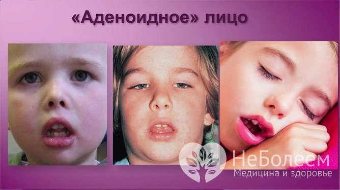 Длительно существующие аденоиды формируют у ребенка «аденоидное лицо»