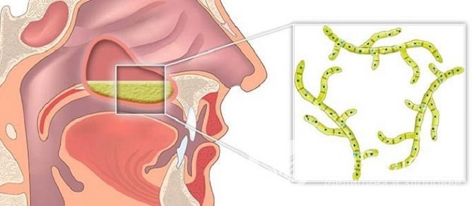 Применение препаратов с противогрибковым действием показано при микотических поражениях пазух носа