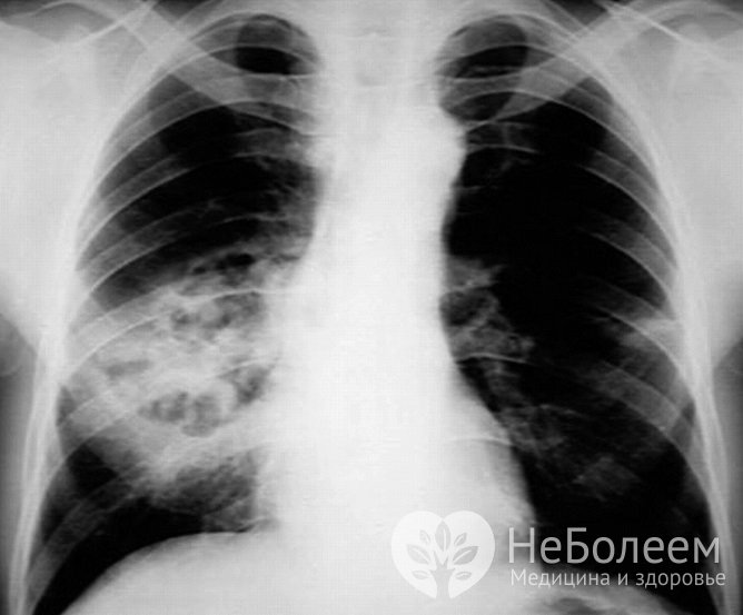 Для постановки диагноза проводится рентген грудной клетки