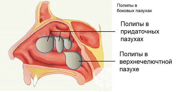 При полипозной форме хронического синусита показано хирургическое лечение