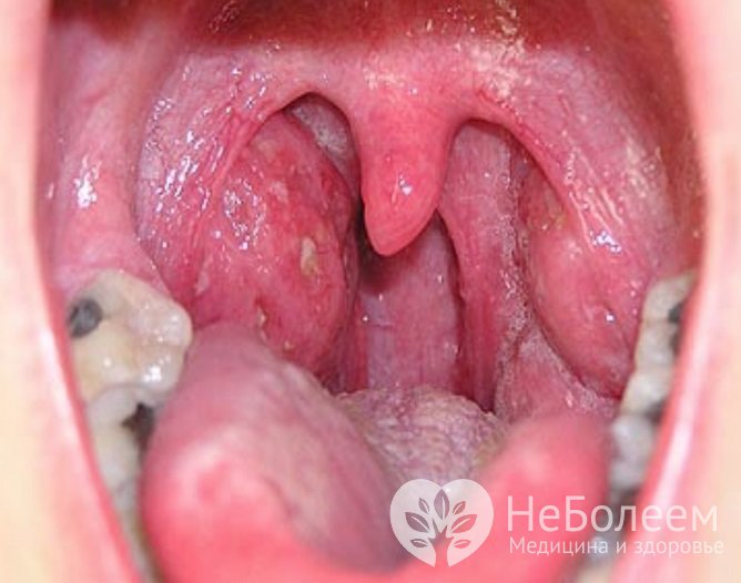 При тонзиллите происходит покраснение и отек слизистой оболочки горла и миндалин, возможно развитие абсцесса