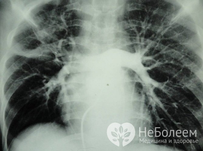 Один из методов диагностики ЛГ – рентгенография грудной клетки