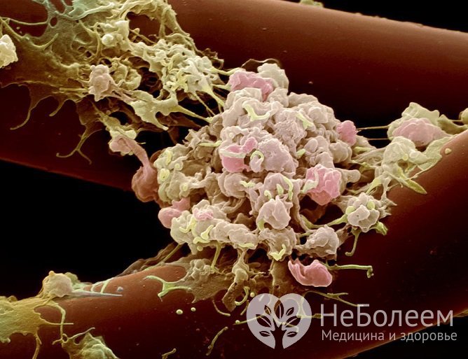 Тромбоциты - кровяные клетки, которые останавливают кровотечение в случае повреждения кровеносного сосуда