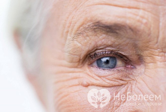 Стабильно повышенное внутриглазное давление, особенно в пожилом возрасте, может указывать на глаукому
