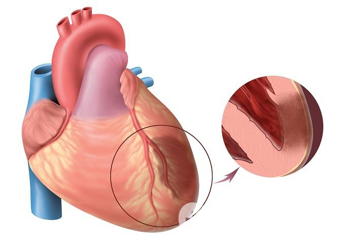Инфарктом миокарда называется гибель участка сердечной мышцы