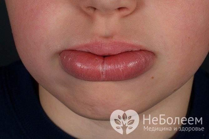 Синдром Мелькерссона - Розенталя – одна из редких причин отека губ