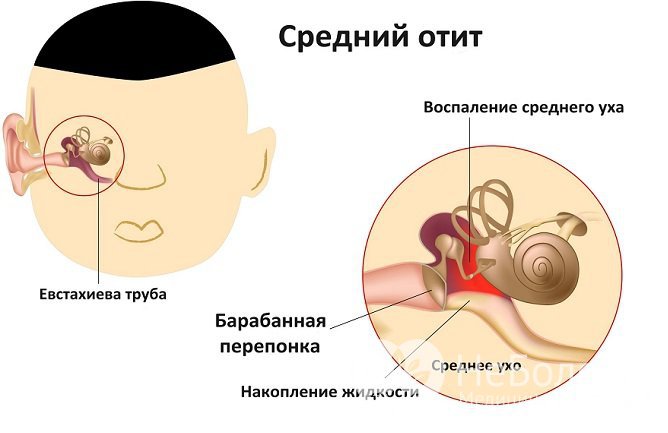 Отит характеризуется нарушением слуха, заложенностью уха, повышением температуры тела