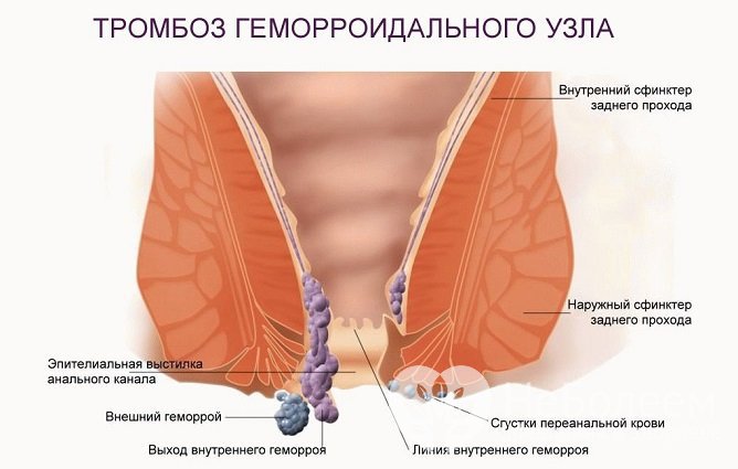 Тромбоз геморроидального узла - одно из опасных последствий запущенного геморроя