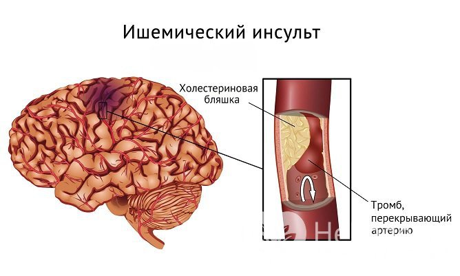 Ишемический инсульт развивается при внезапном прекращении кровотока в одном из сосудов мозга