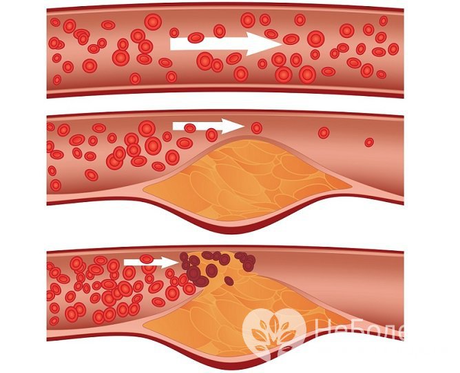 Атеросклероз коронарных артерий - непосредственная причина инфаркта сердца