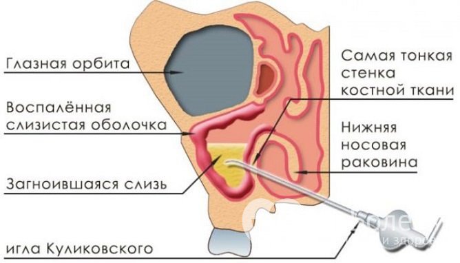 На фото – схема проведения прокола гайморовой пазухи при помощи иглы Куликовского