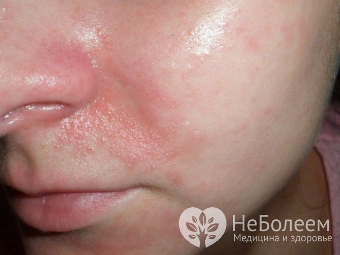 Длительное раздражение кожи возле носа приводит к появлению мацерации