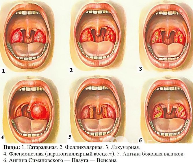 Виды ангины у детей и взрослых: симптомы, как выглядит горло, лечение