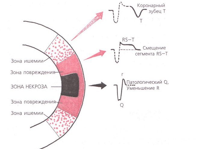 Если на ЭКГ определяется зубец Q, говорят о трансмуральном, или Q-инфаркте