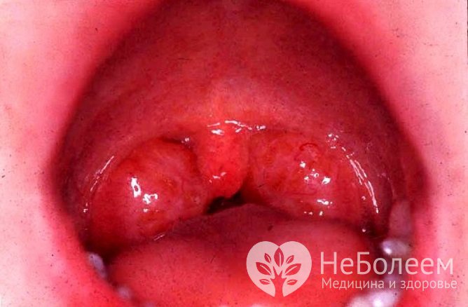 Симптомы ангины варьируют в зависимости от возбудителя и наличия сопутствующих патологий