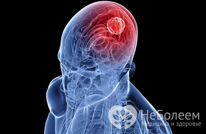 Причиной внутричерепной гипертензии может стать новообразование в головном мозге