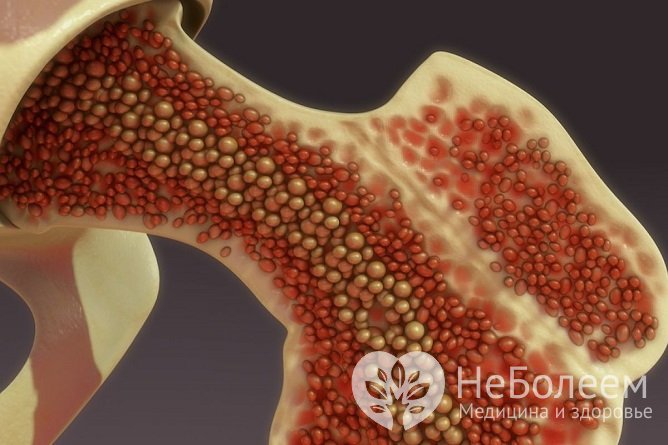  Миелодиспластический синдром развивается из-за нарушений в красном костном мозге