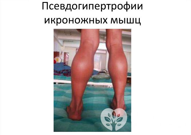 Для миопатии Дюшенна характерна псевдогипертрофия икроножных мышц, эта форма также называется псевдогипертрофической