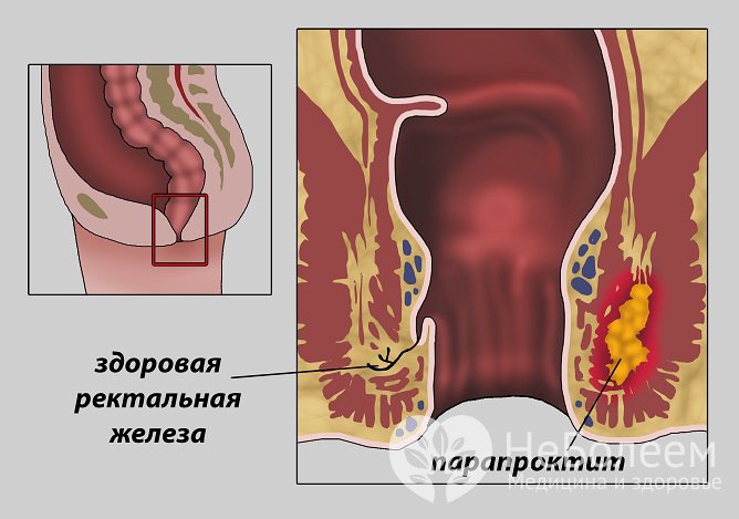 При остром парапроктие развивается очаг гнойного воспаления в околопрямокишечной области