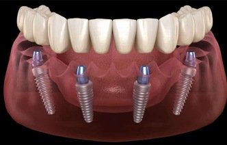 Имплантация зубов All-on-4: преимущества и недостатки методики моментального протезирования
