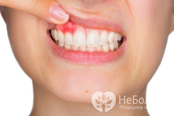 Абсцесс зуба представляет собой гнойник, расположенный в околозубных тканях