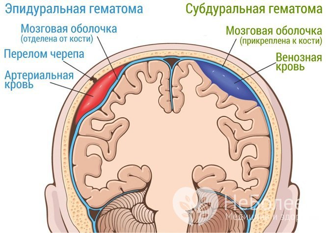 Эпидуральная гематома формируется над твердой мозговой оболочкой, при субдуральной форме кровь скапливается между твердой и арахноидальной оболочками
