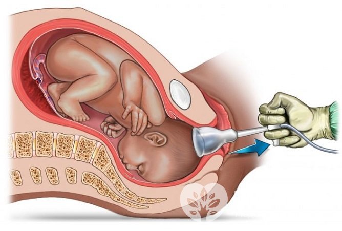 Патология может быть следствием применения медицинского инструментария для извлечения плода во время родов