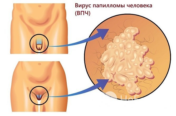Аногенитальные бородавки, или кондиломы, вызываются вирусом папилломы человека