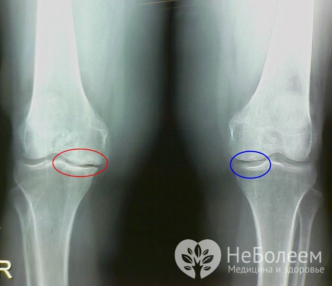 Гонартроз коленного сустава 2 степени: симптомы, диагностика, лечение, профилактика