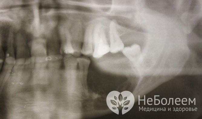 В клинической практике чаще встречаются кисты нижней челюсти