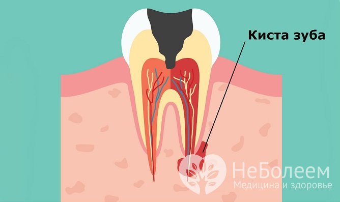 Прикорневая киста зуба развивается вследствие распространения инфекции на окружающие корень ткани