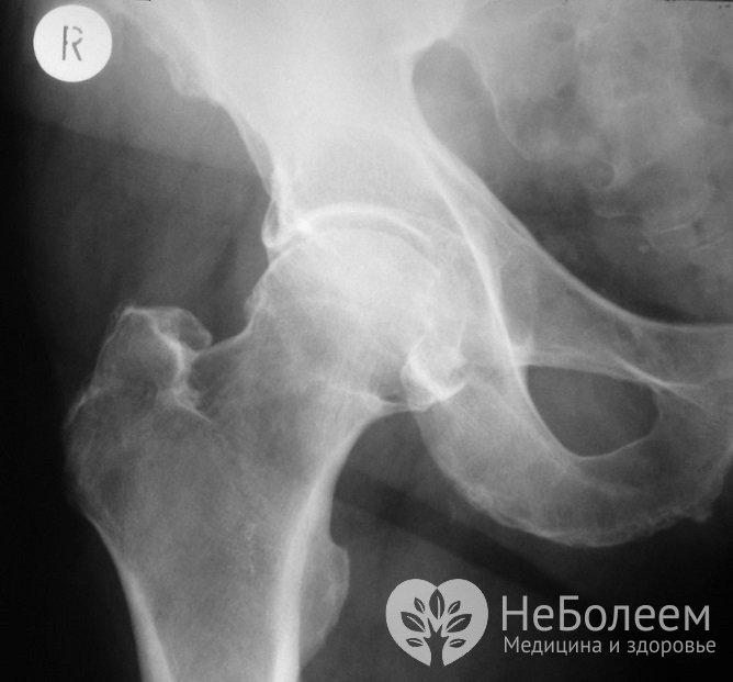 Для постановки диагноза обычно проводится рентгенография таза