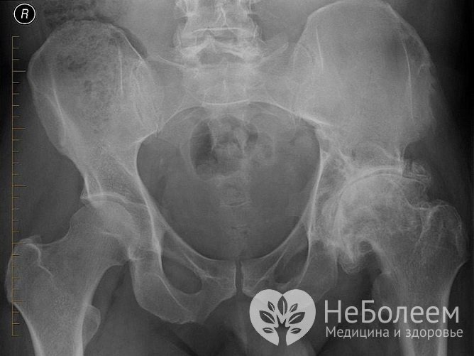 Рентгенография позволяет определить степень поражения сустава
