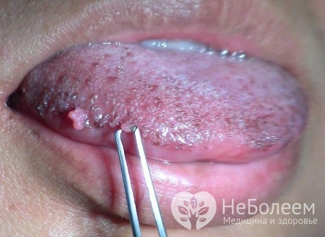 Папилломы на языке вызываются постоянным травмированием слизистой оболочки и/или инфицированием ВПЧ