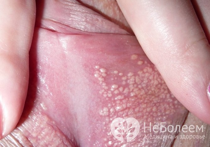 Причиной появления папиллом на половых губах служит инфицирование папилломавирусом