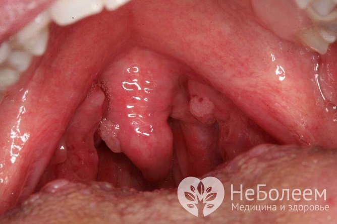 Папилломы в полости рта могут перерождаться в рак, особенно если постоянно травмируются