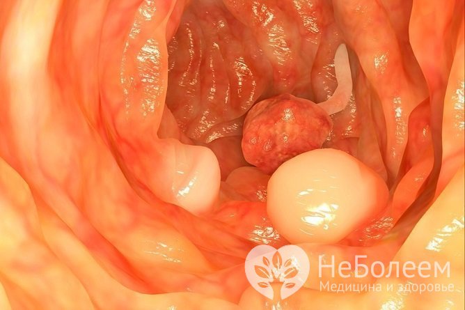 Полипы могут локализоваться в разных частях желудочно-кишечного тракта
