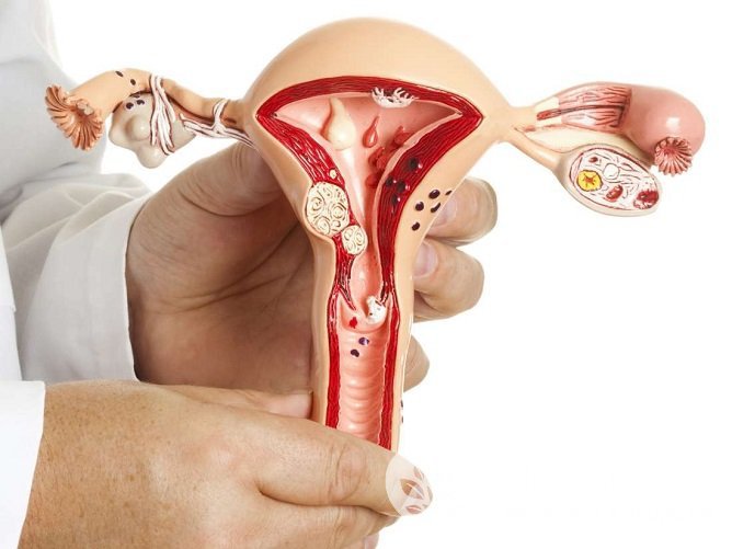 Полипы в матке являются результатом патологического разрастания клеток эндометрия