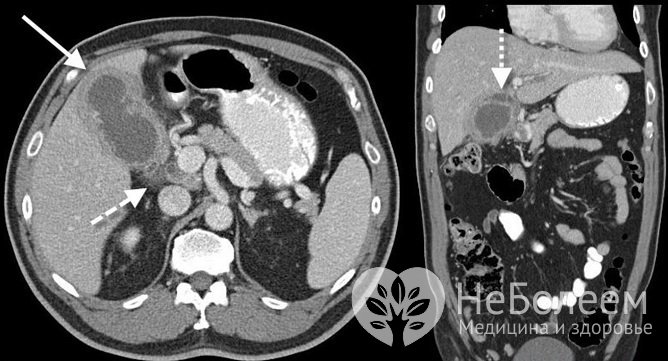 Для выявления мелких полипов и других болезней органа назначается компьютерная томография