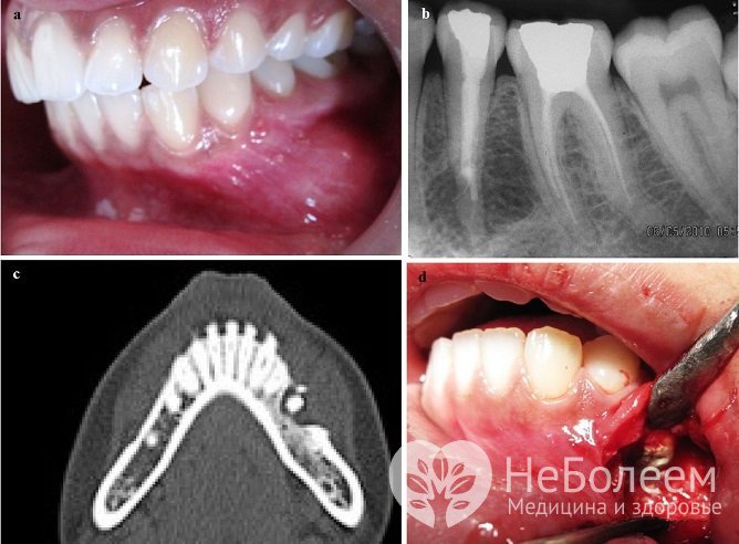 Радикулярная киста является следствием воспалительного процесса в зубе