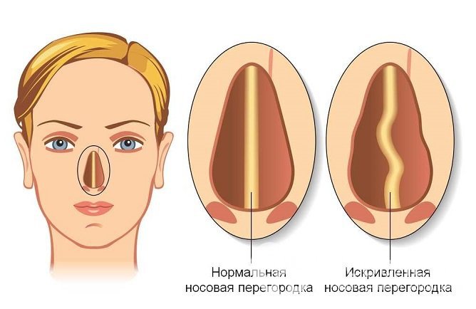 При боковой травме может произойти искривление носовой перегородки