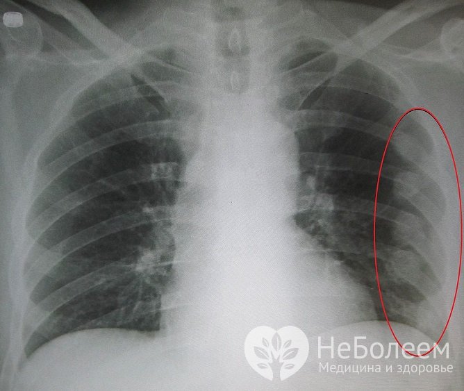 При подозрении на перелом ребер назначается рентген