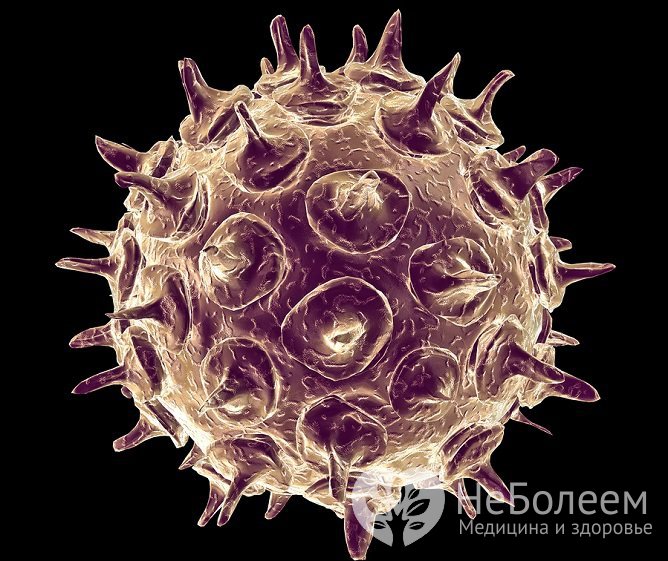 Причиной болезни является герпесвирус Varicella zoster