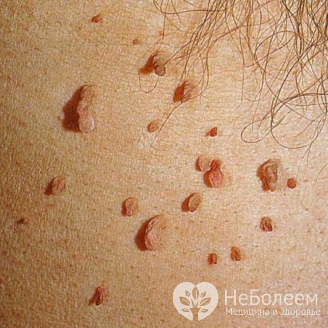 Основной симптом инфекции ВПЧ – появление кожных новообразований, бородавок, папиллом или остроконечных кондилом