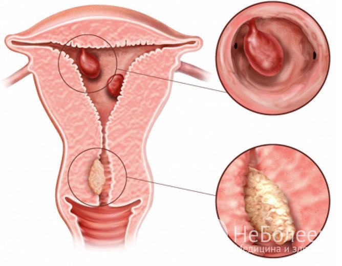 Полип эндометрия – патологическое новообразование, возникающее из-за разрастания его клеток