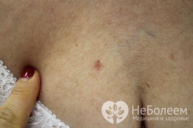 Базальноклеточный рак кожи на начальных этапах может принимать вид родинки