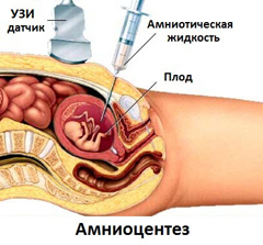 Процедура Амниоцентеза