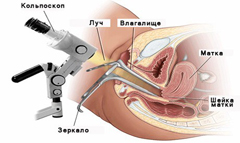 Биопсия шейки матки