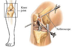 Артроскопия коленного сустава