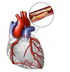 Холестериновые бляшки на сосудах сердца